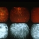 Choroiditis Choroiditis